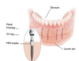 Implants1