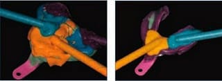 Injecting PVS Aquasil Impression Material Injecting PVS Aquasil Impression Material