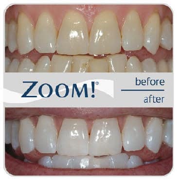 Zoom Before and After Photo