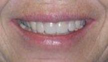 After porcelain crowns