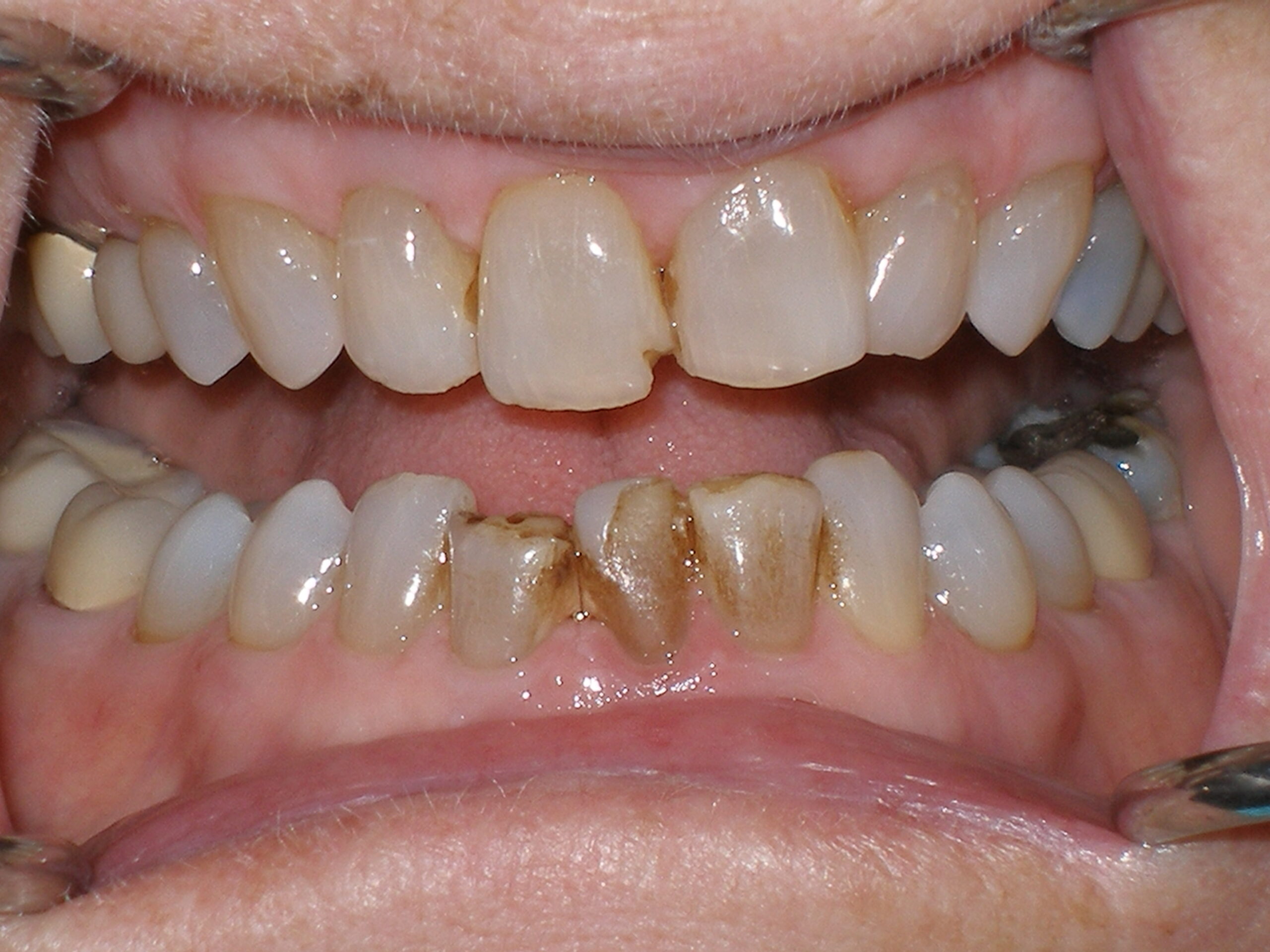 Before composite veneers + bonding, case 19
