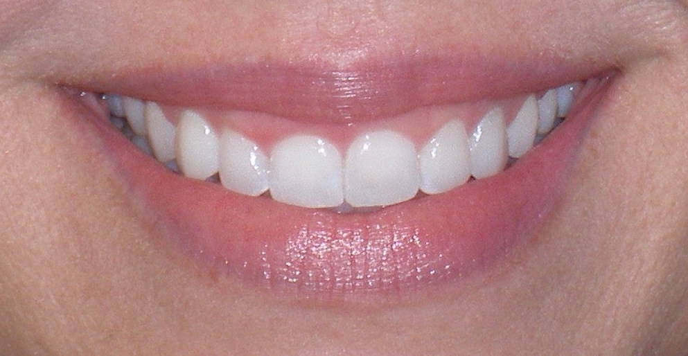 Before laser gum contouring, case 25