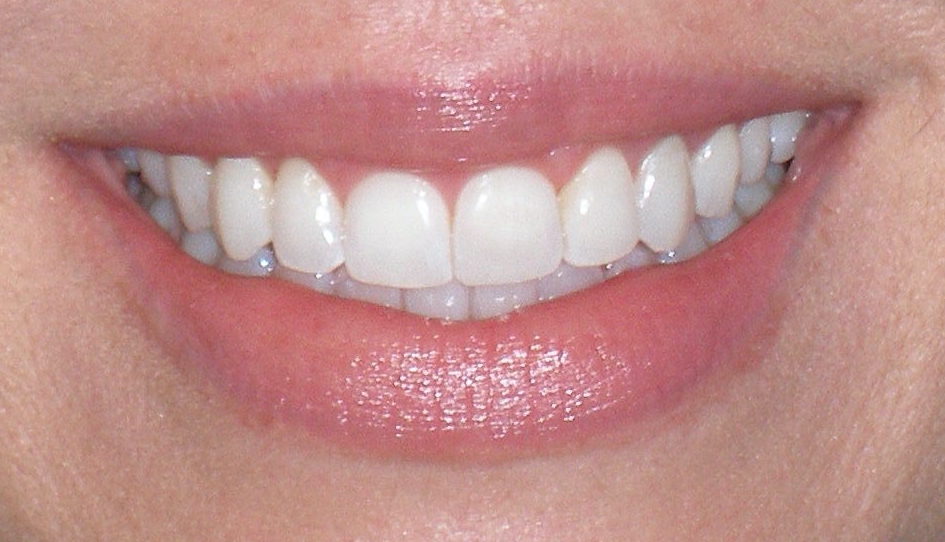 After laser gum contouring, case 25