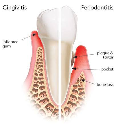 Tartar and periodontal disease diagram Diagram comparing gingivitis with periodontitis, including plaque, tartar, pockets, and bone loss