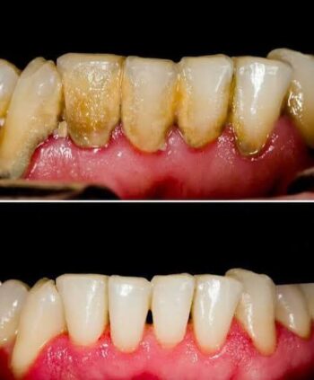 Treating Periodontal Disease1 Teeth and gums before and after removal of visible tartar deposits