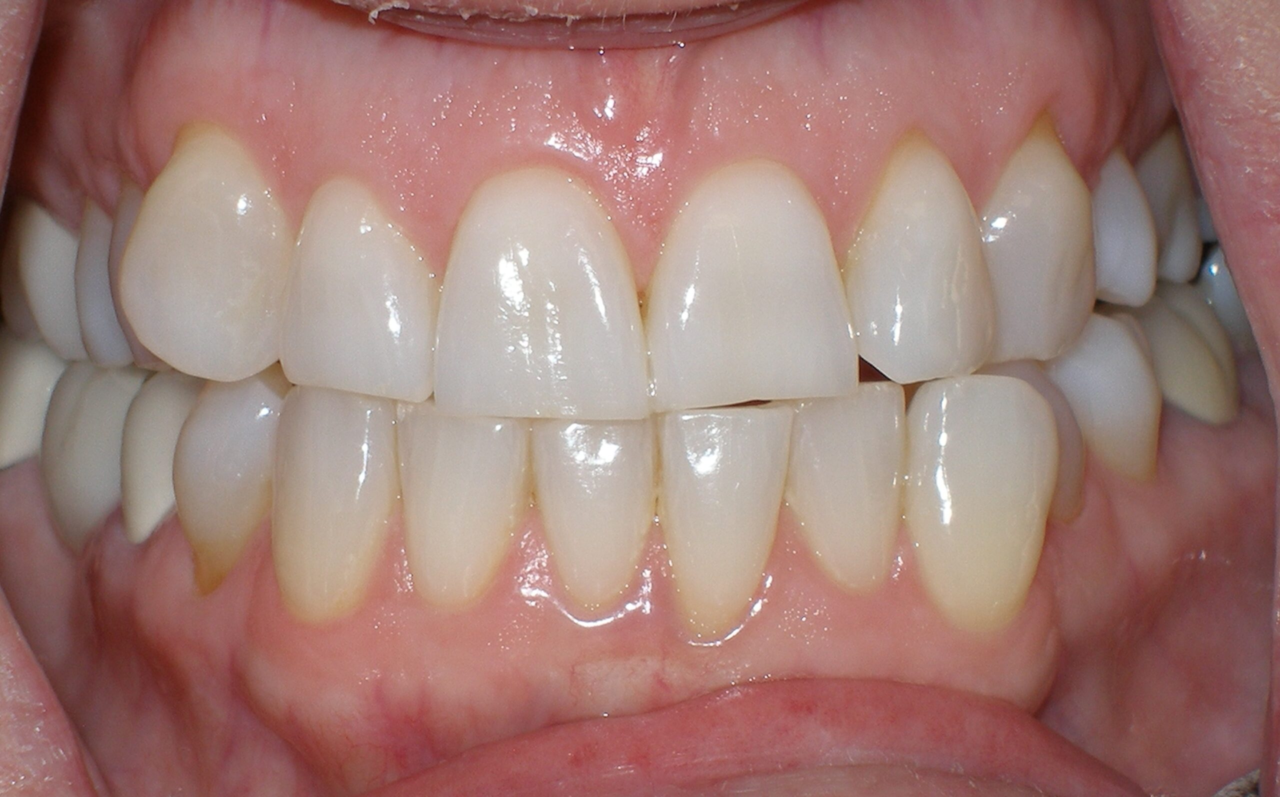 Before zoom teeth whitening, case 29