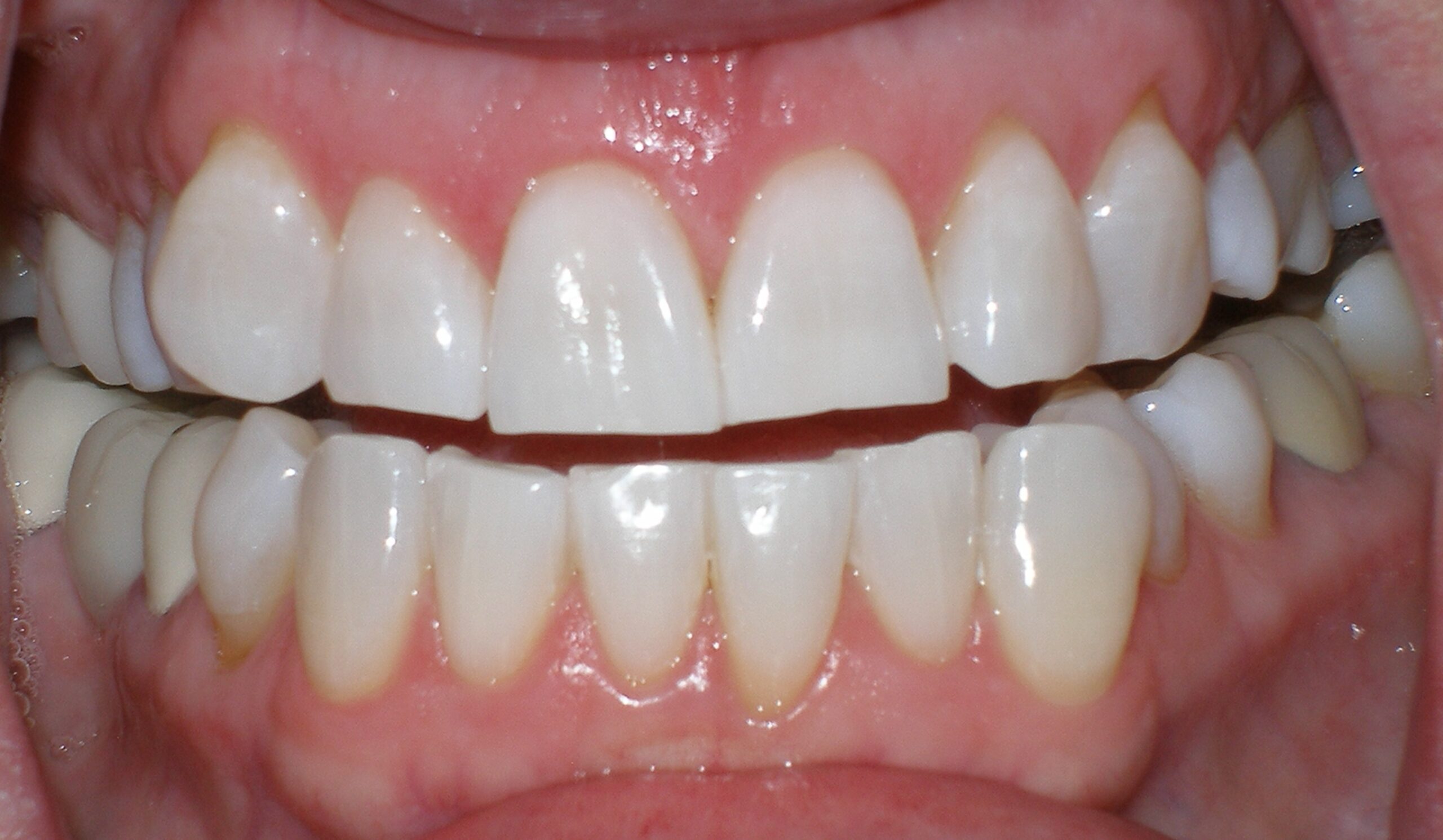 After zoom teeth whitening, case 29