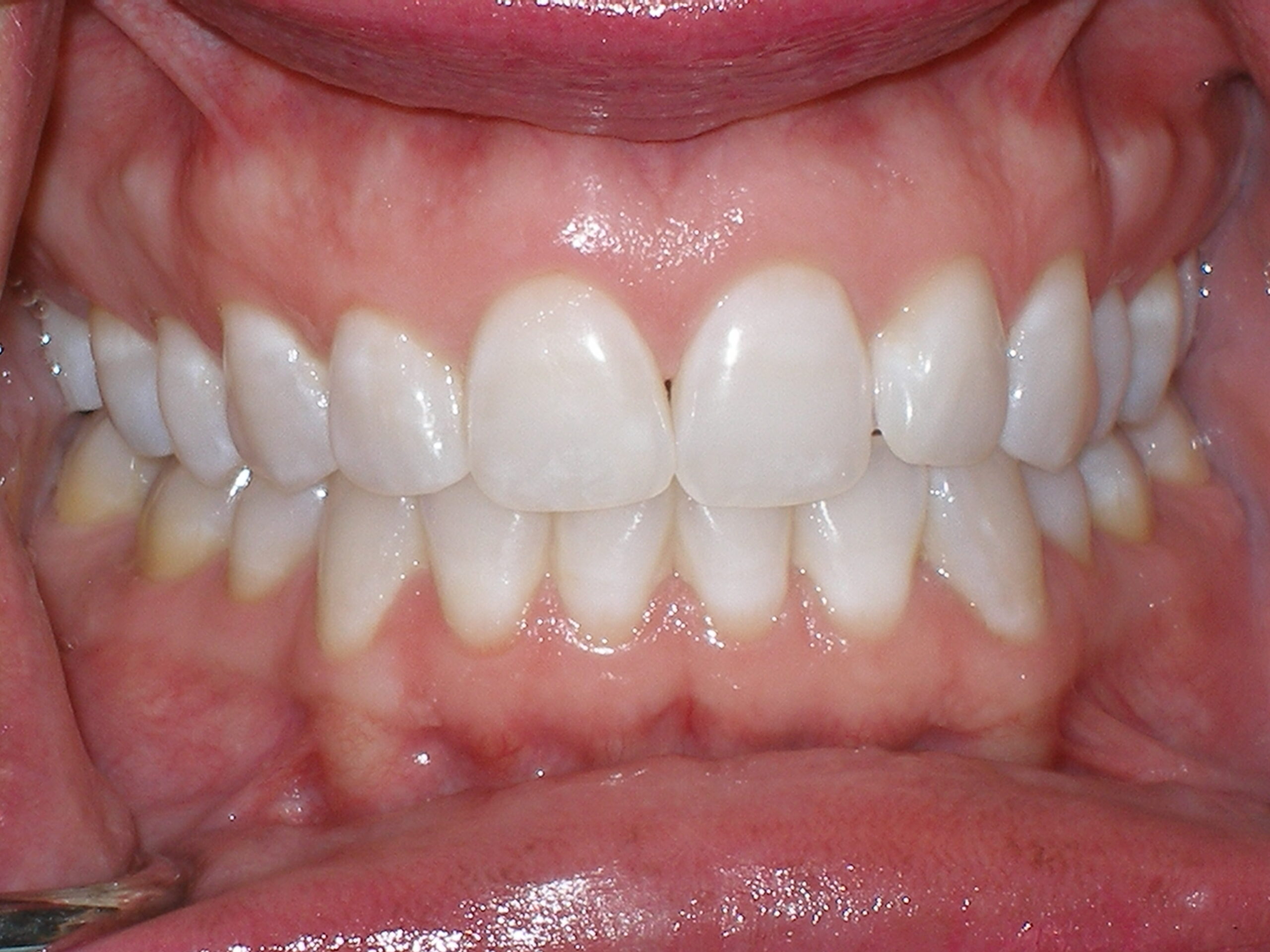 Before zoom teeth whitening, case 27