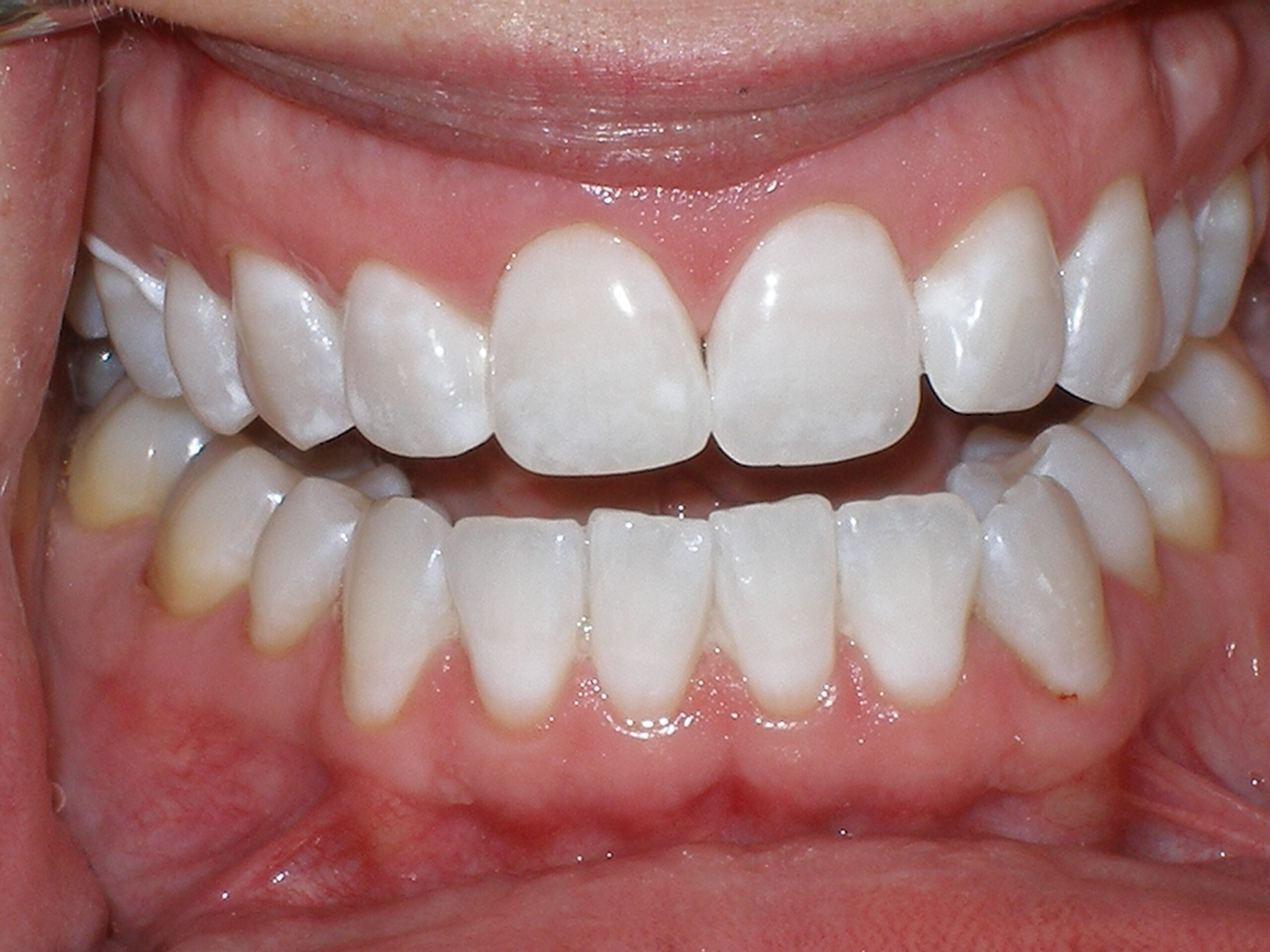 After zoom teeth whitening, case 27