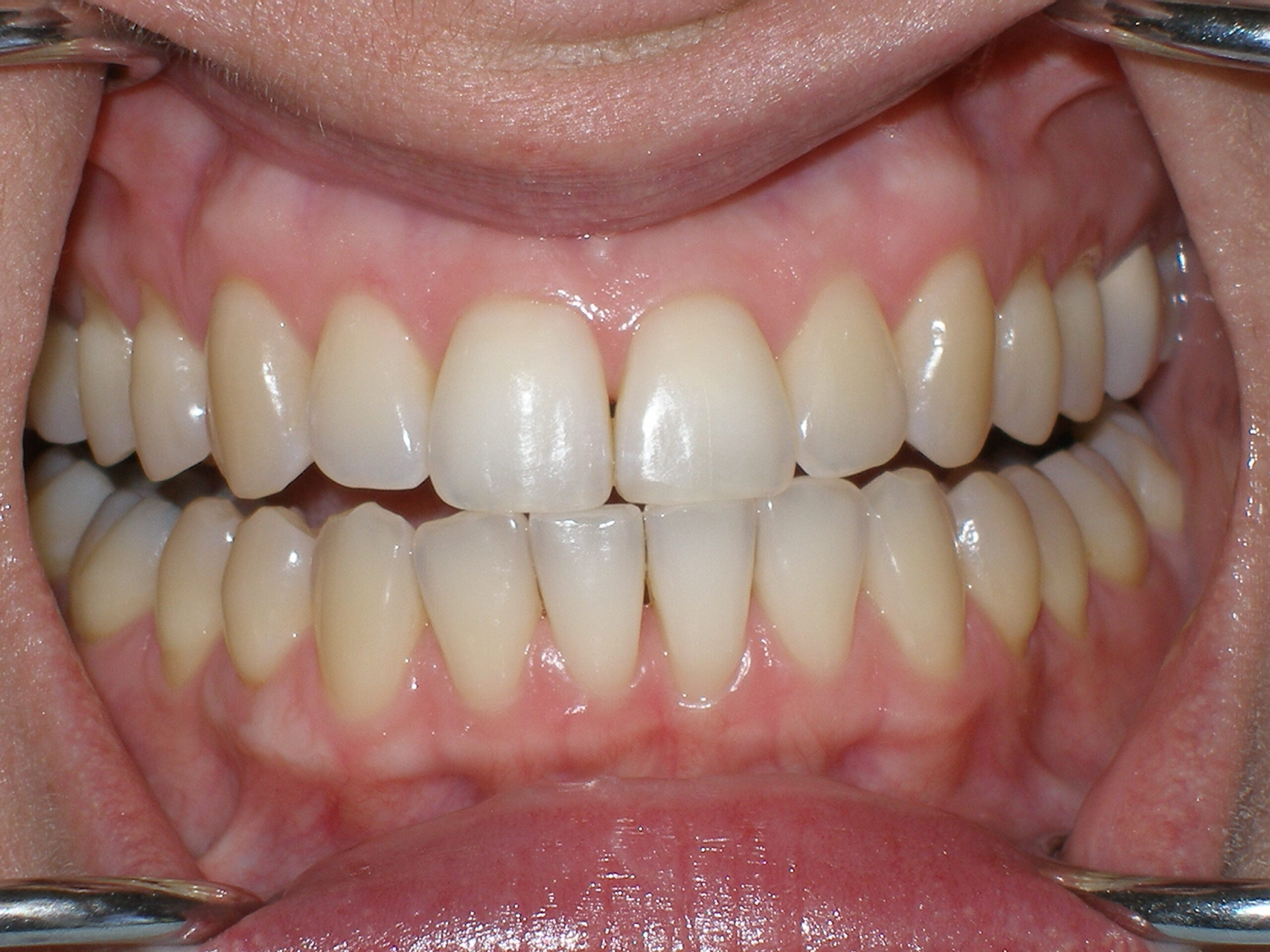 Before Zoom teeth whitening