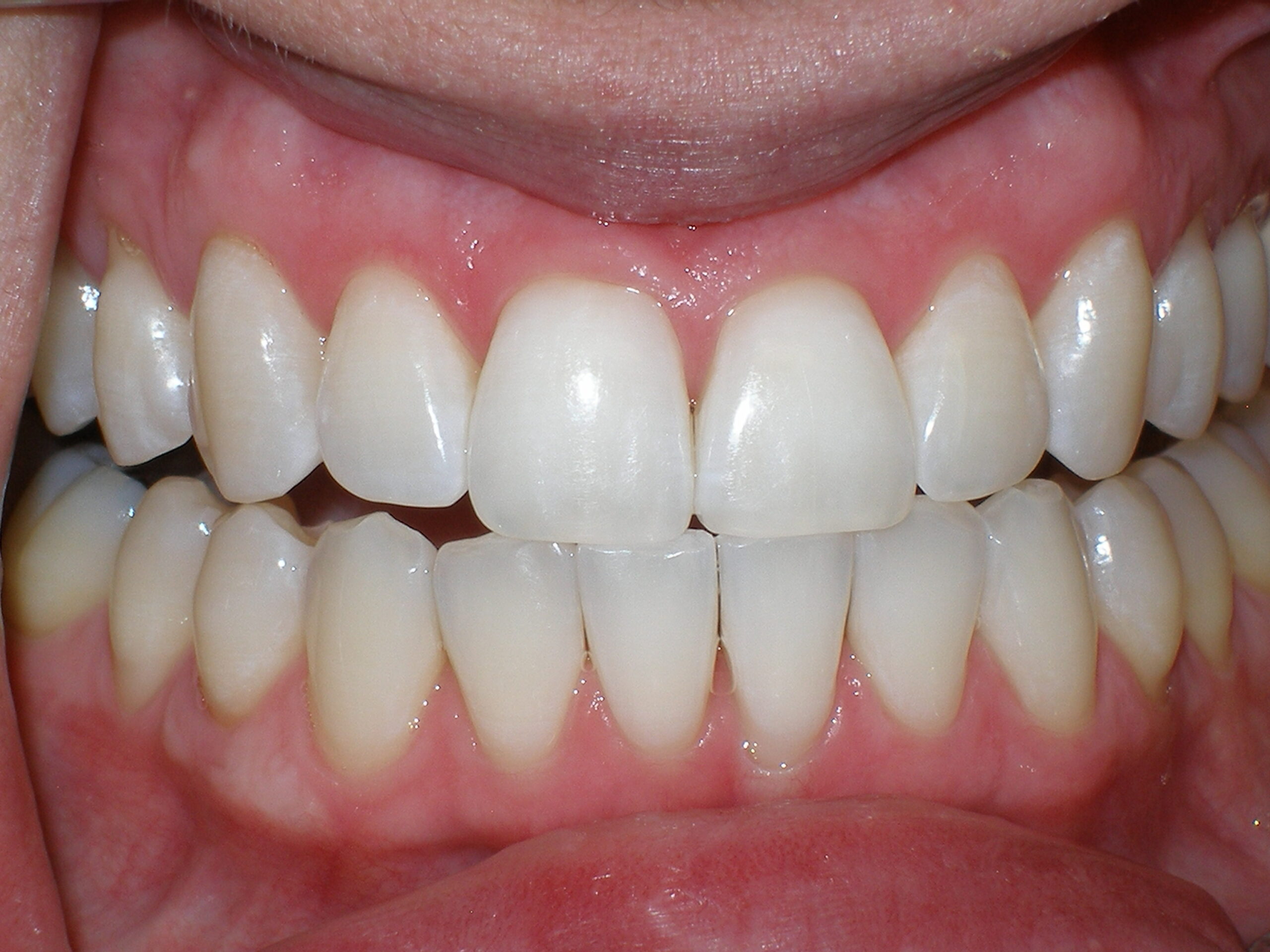 After Zoom teeth whitening