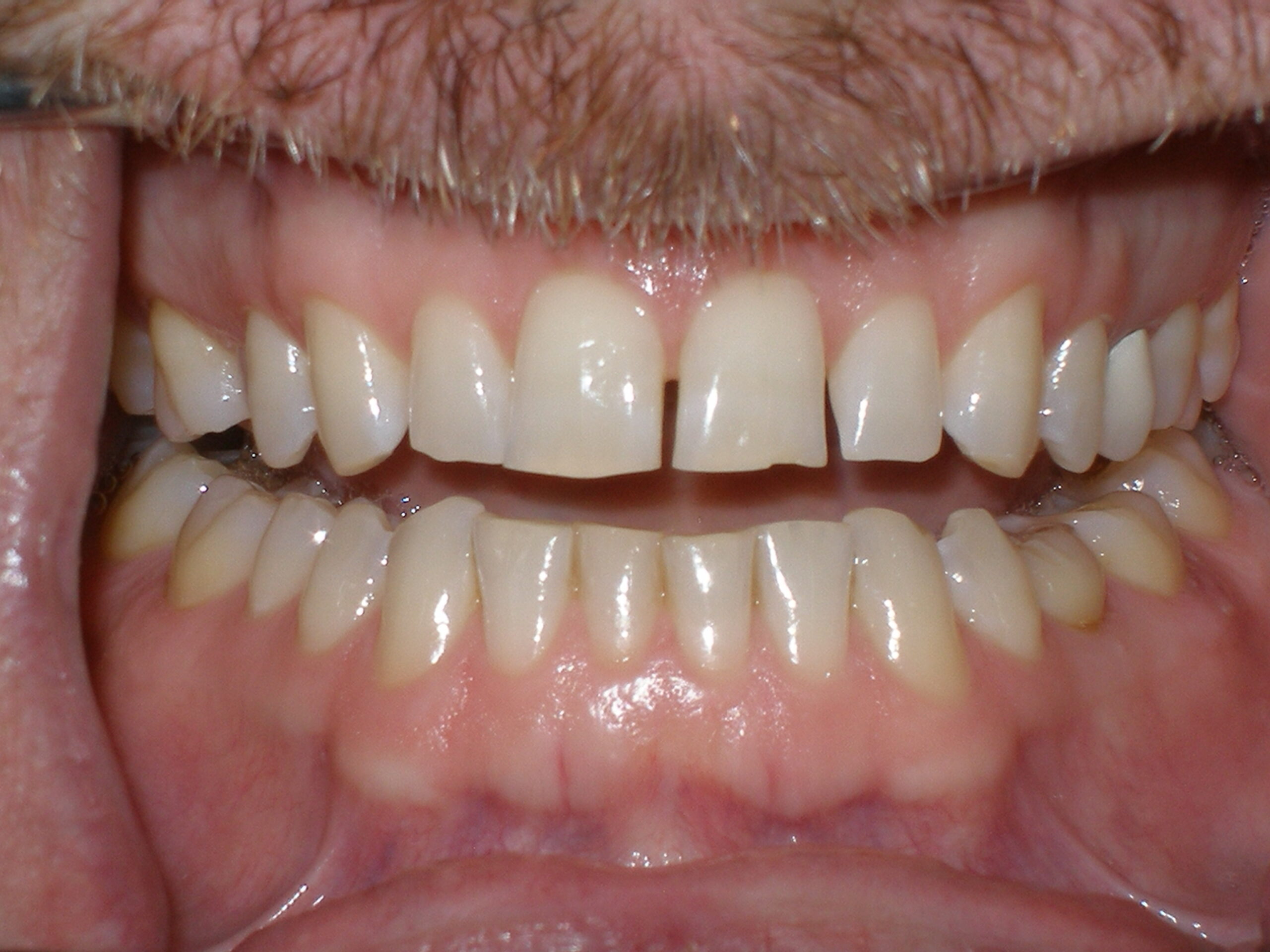 Before zoom teeth whitening, case 28