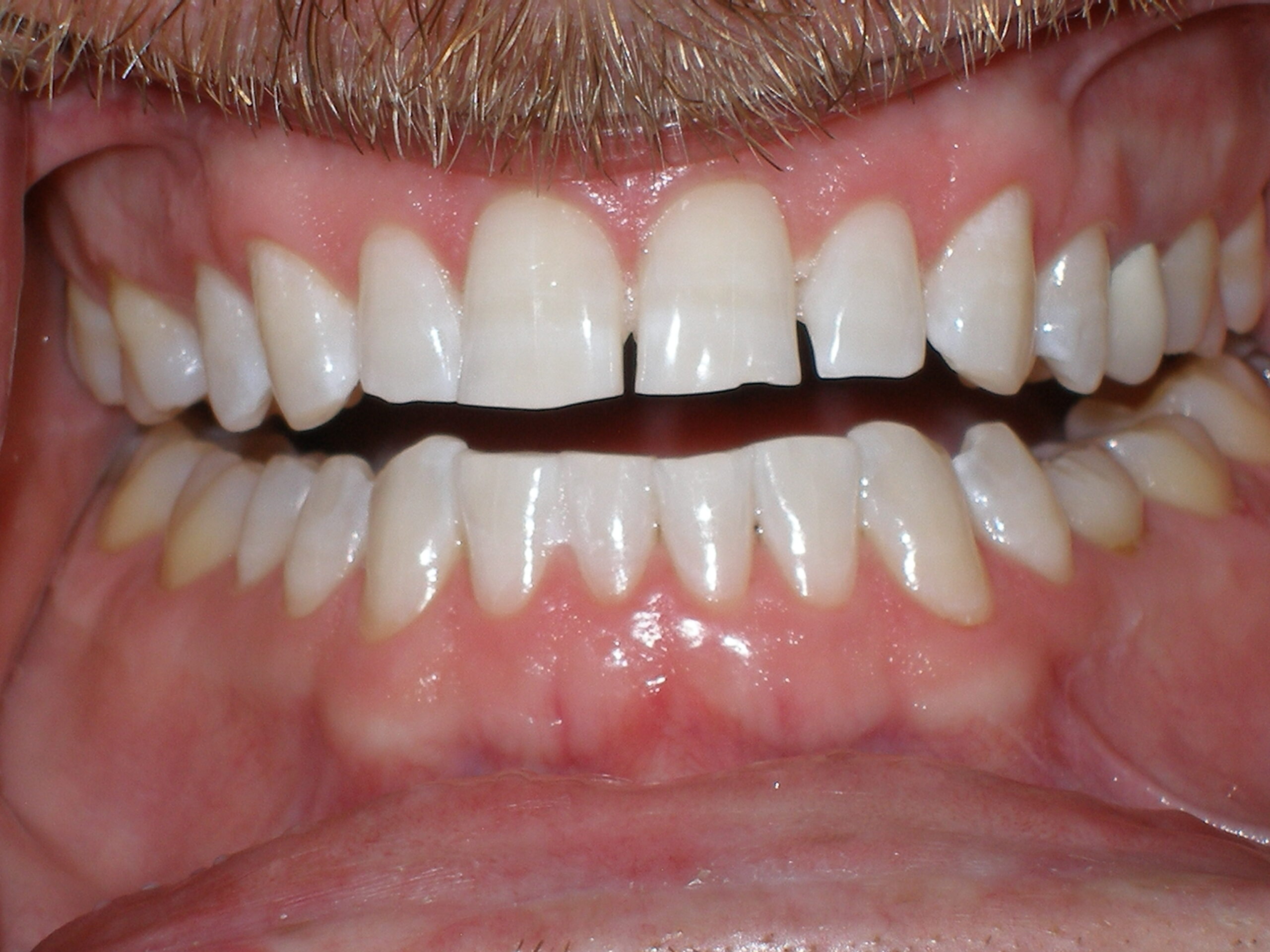 After zoom teeth whitening, case 28